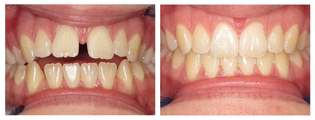 Aging Gracefully Invisalign Natural Beauty And Dr George Harounis Expertise 