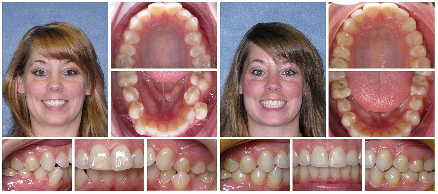 Elevate Your Game Invisalign Active Sports And The Expertise Of Dr George Harouni 