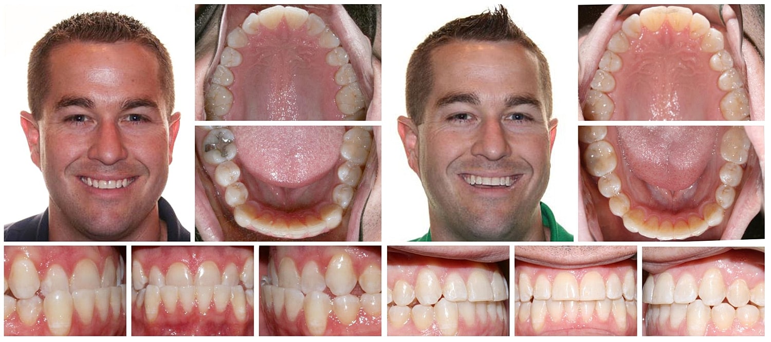 Before and after dental treatment images comparison.
