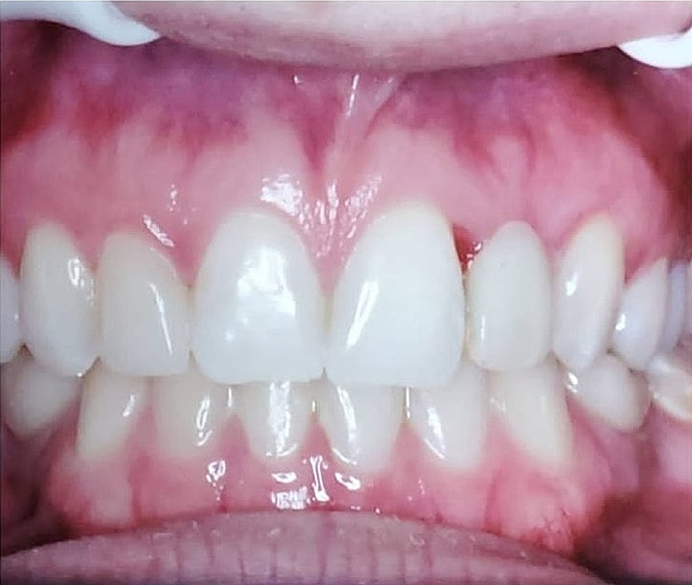 Before & Afters Before & After
