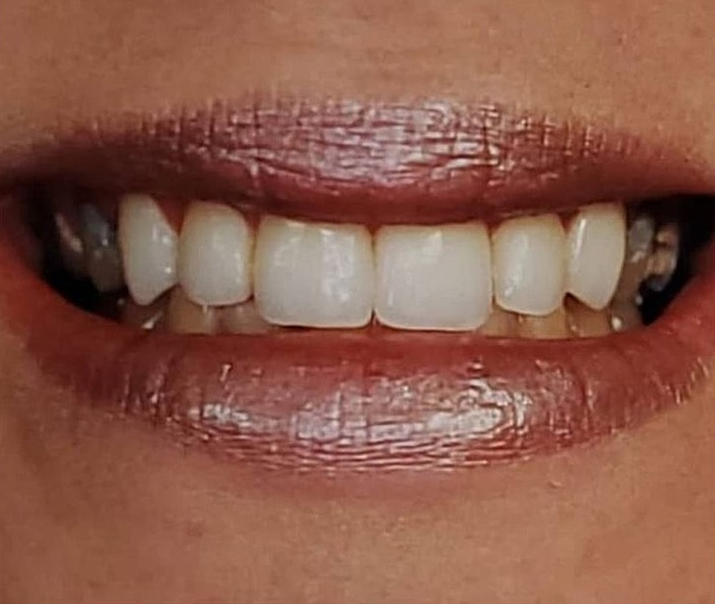 Before & Afters Before & After
