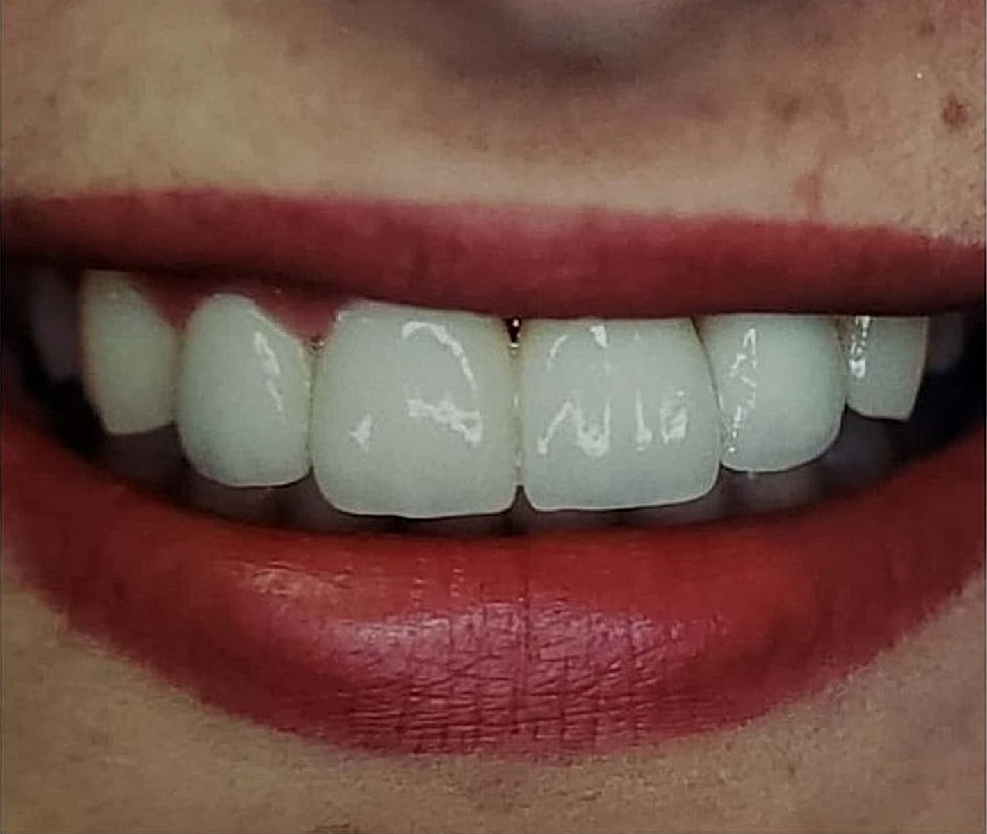 Before & Afters Before & After